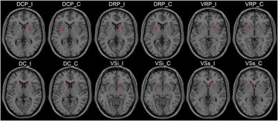 Altered Cortical-Striatal Network in Patients With Hemifacial Spasm